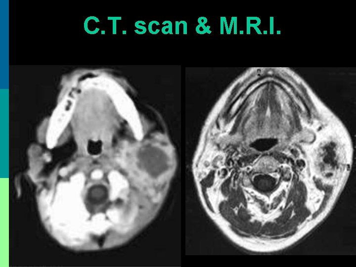 C. T. scan & M. R. I. 