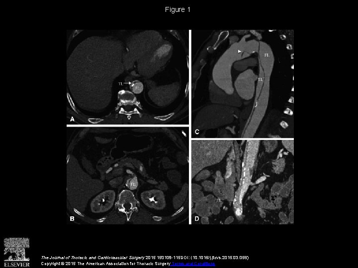 Figure 1 The Journal of Thoracic and Cardiovascular Surgery 2015 150108 -115 DOI: (10.