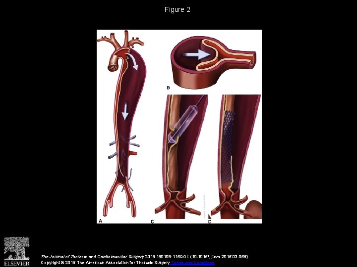 Figure 2 The Journal of Thoracic and Cardiovascular Surgery 2015 150108 -115 DOI: (10.