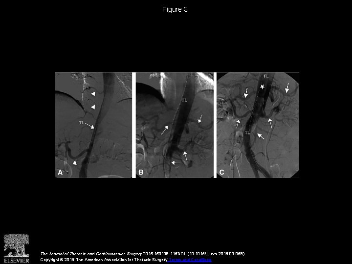 Figure 3 The Journal of Thoracic and Cardiovascular Surgery 2015 150108 -115 DOI: (10.