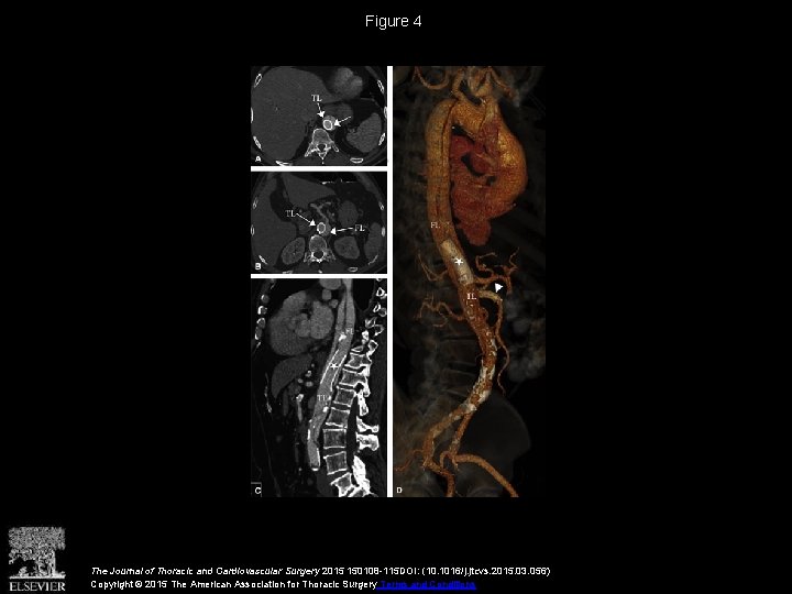 Figure 4 The Journal of Thoracic and Cardiovascular Surgery 2015 150108 -115 DOI: (10.