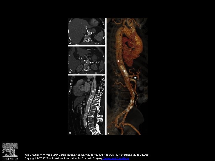 The Journal of Thoracic and Cardiovascular Surgery 2015 150108 -115 DOI: (10. 1016/j. jtcvs.