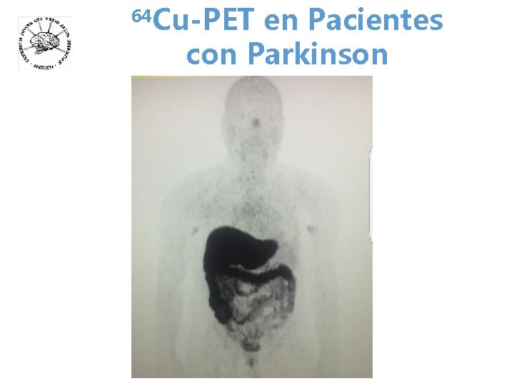 64 Cu-PET en Pacientes con Parkinson 