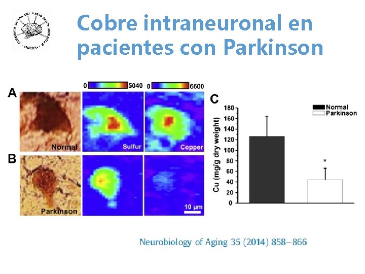 Cobre intraneuronal en pacientes con Parkinson 