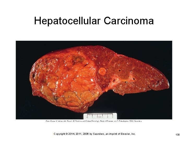 Hepatocellular Carcinoma • Copyright © 2014, 2011, 2006 by Saunders, an imprint of Elsevier,