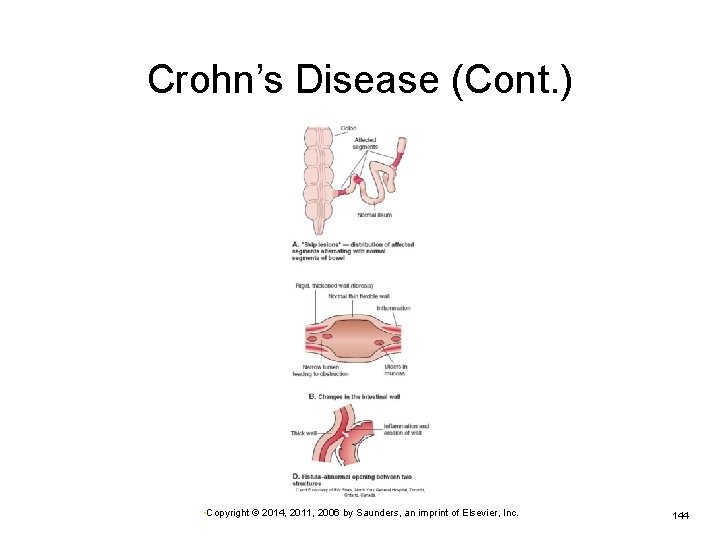 Crohn’s Disease (Cont. ) • Copyright © 2014, 2011, 2006 by Saunders, an imprint