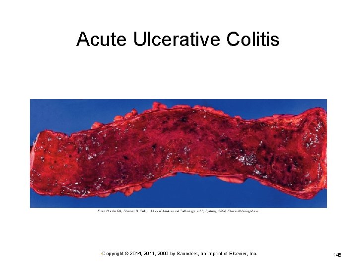 Acute Ulcerative Colitis • Copyright © 2014, 2011, 2006 by Saunders, an imprint of