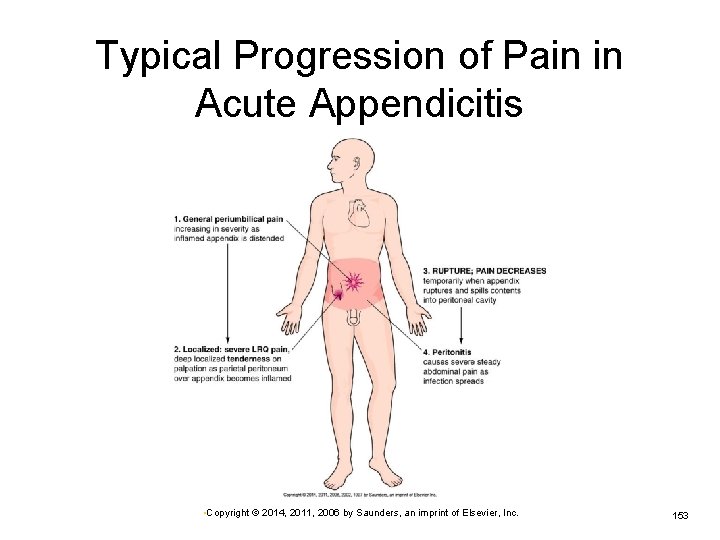 Typical Progression of Pain in Acute Appendicitis • Copyright © 2014, 2011, 2006 by