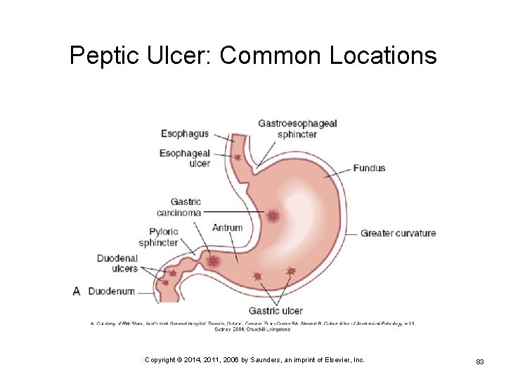 Peptic Ulcer: Common Locations • Copyright © 2014, 2011, 2006 by Saunders, an imprint