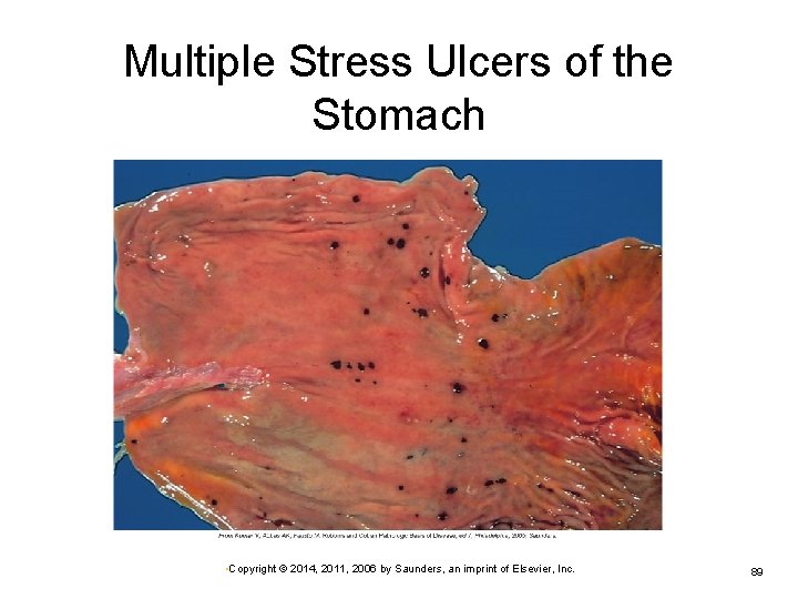 Multiple Stress Ulcers of the Stomach • Copyright © 2014, 2011, 2006 by Saunders,