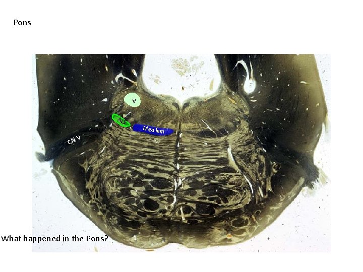 Pons V ALS CN V What happened in the Pons? Med lem 