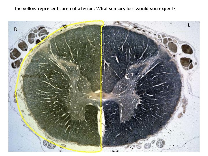 The yellow represents area of a lesion. What sensory loss would you expect? R