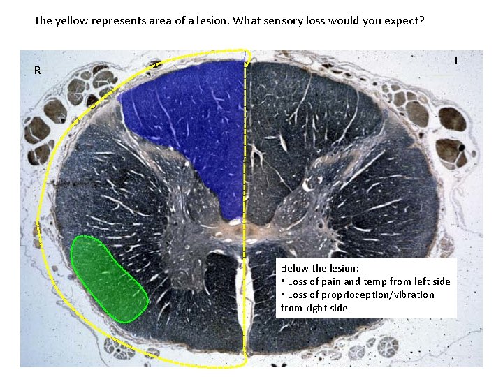 The yellow represents area of a lesion. What sensory loss would you expect? L