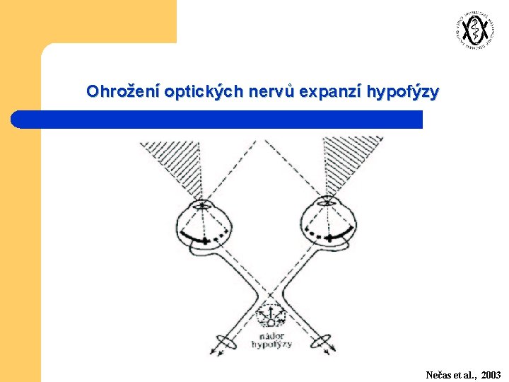 Ohrožení optických nervů expanzí hypofýzy Nečas et al. , 2003 