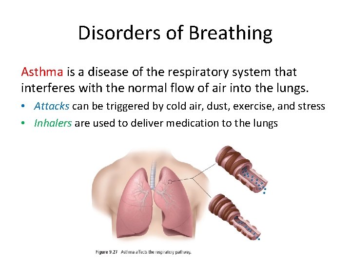 Disorders of Breathing Asthma is a disease of the respiratory system that interferes with