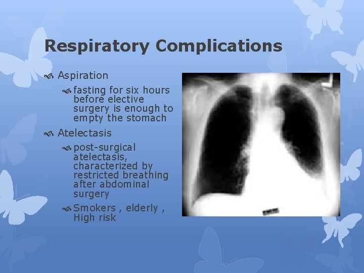 Respiratory Complications Aspiration fasting for six hours before elective surgery is enough to empty