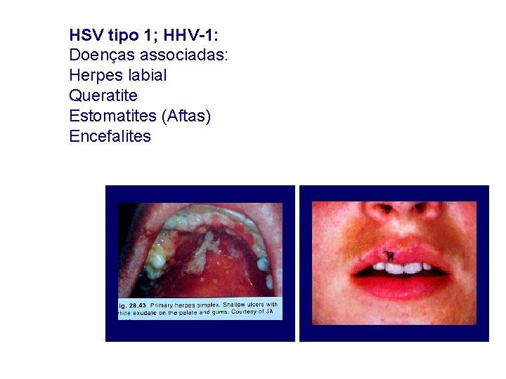 HSV tipo 1; HHV-1: Doenças associadas: Herpes labial Queratite Estomatites (Aftas) Encefalites HSV tipo 1; HHV-1: Doenças associadas: Herpes labial Queratite Estomatites (Aftas) Encefalites