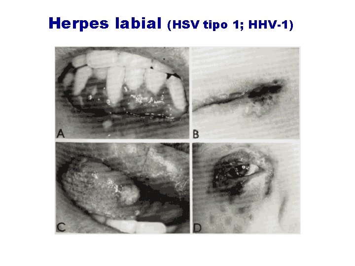Herpes labial (HSV tipo 1; HHV-1) Herpes labial (HSV tipo 1; HHV-1)