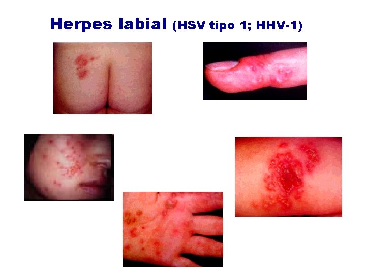 Herpes labial (HSV tipo 1; HHV-1) Herpes labial (HSV tipo 1; HHV-1)