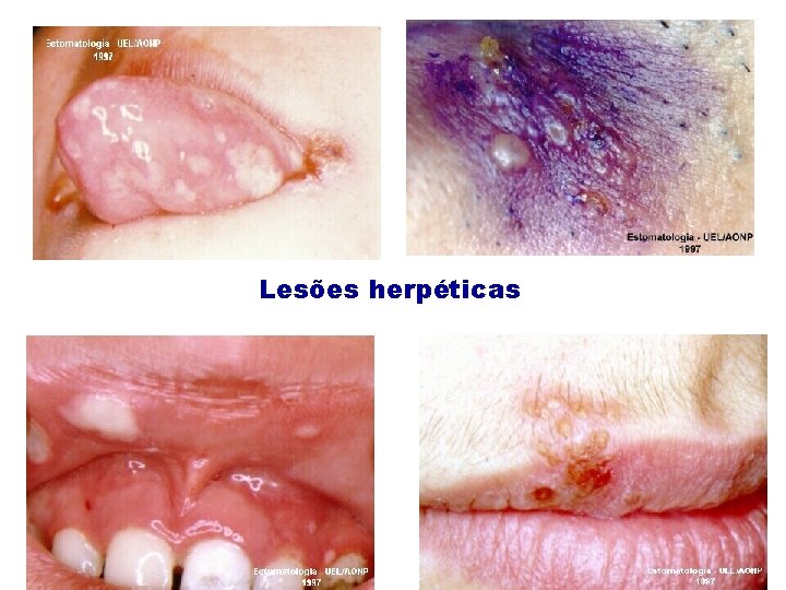 Lesões herpéticas Lesões herpéticas