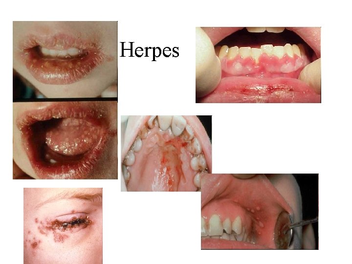 Herpes Herpes