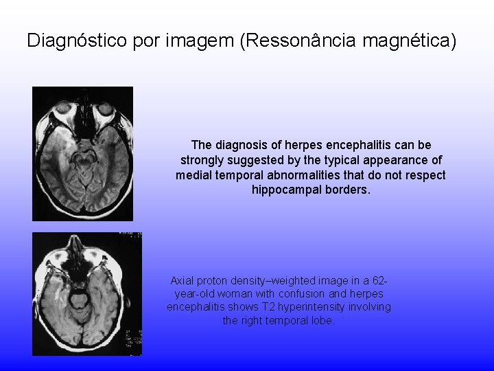 Diagnóstico por imagem (Ressonância magnética) The diagnosis of herpes encephalitis can be strongly suggested Diagnóstico por imagem (Ressonância magnética) The diagnosis of herpes encephalitis can be strongly suggested
