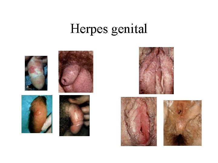 Herpes genital Herpes genital