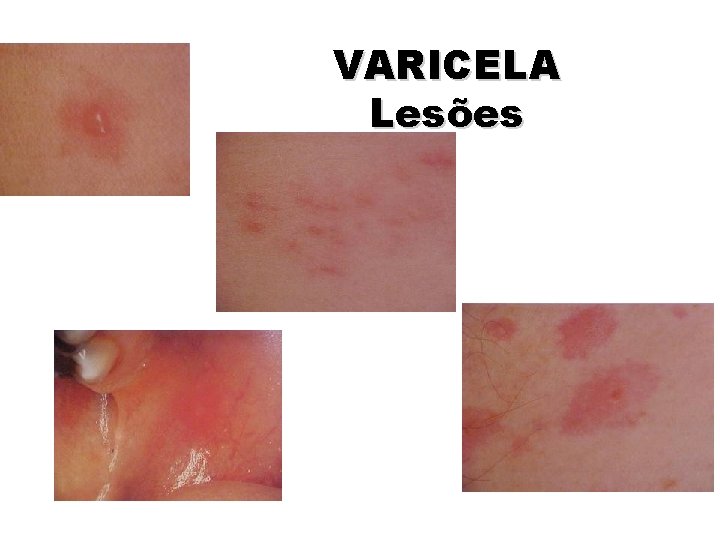 VARICELA Lesões VARICELA Lesões