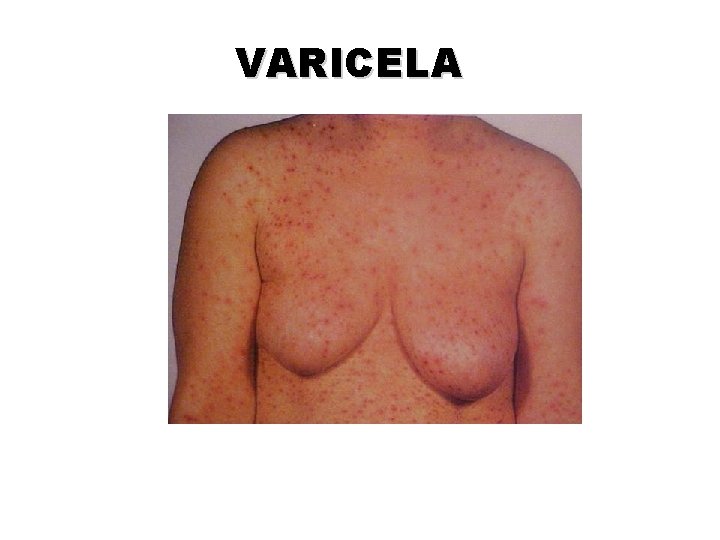 VARICELA VARICELA