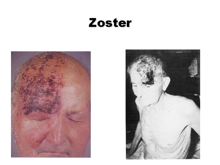Zoster Zoster