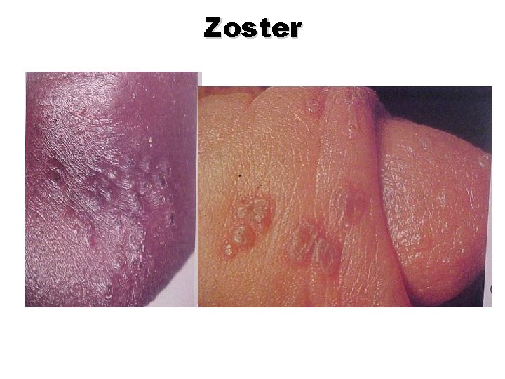 Zoster Zoster