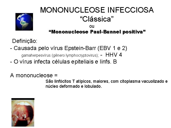 MONONUCLEOSE INFECCIOSA “Clássica” ou “Mononucleose Paul-Bunnel positiva” Definição: - Causada pelo vírus Epstein-Barr (EBV MONONUCLEOSE INFECCIOSA “Clássica” ou “Mononucleose Paul-Bunnel positiva” Definição: - Causada pelo vírus Epstein-Barr (EBV