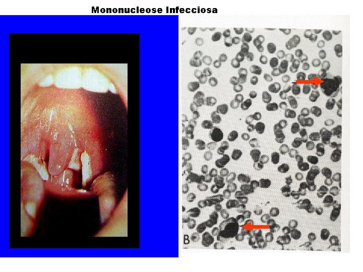 Mononucleose Infecciosa Mononucleose Infecciosa