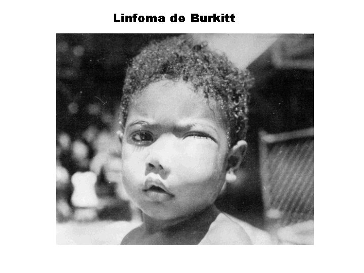 Linfoma de Burkitt Linfoma de Burkitt