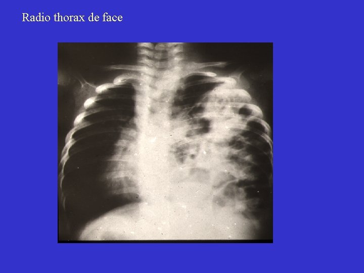 Radio thorax de face 