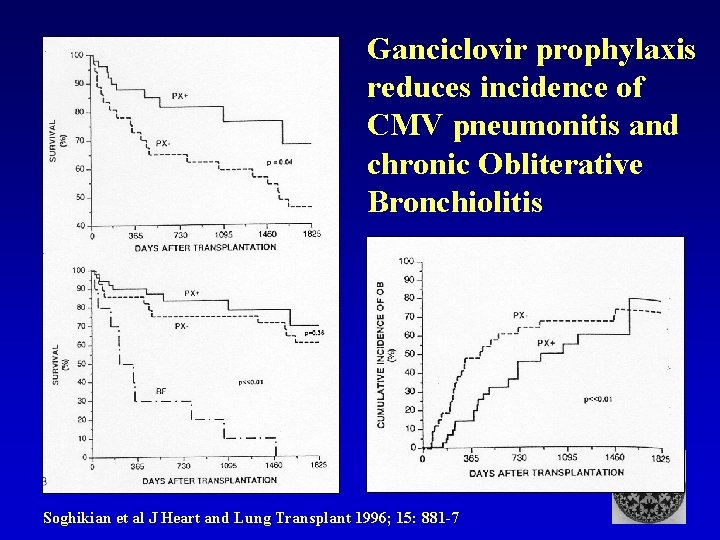 Ganciclovir prophylaxis reduces incidence of CMV pneumonitis and chronic Obliterative Bronchiolitis Soghikian et al