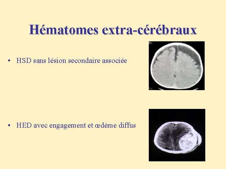 Hématomes extra-cérébraux • HSD sans lésion secondaire associée • HED avec engagement et œdème