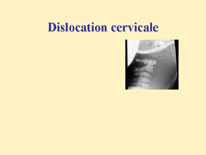 Dislocation cervicale 