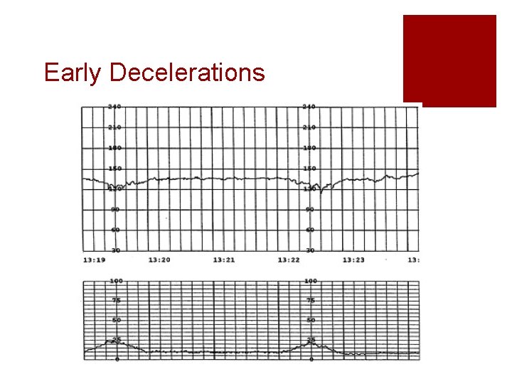 Early Decelerations Early Decelerations