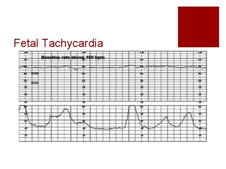 Fetal Tachycardia Fetal Tachycardia