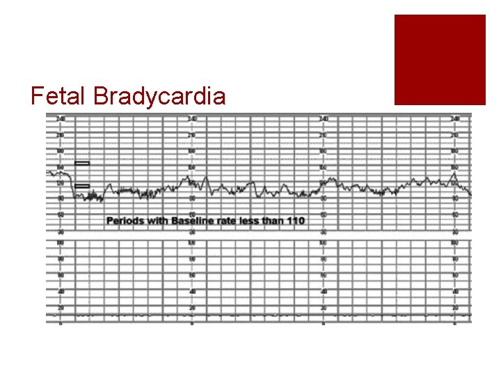 Fetal Bradycardia Fetal Bradycardia