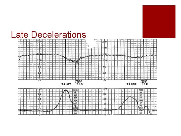 Late Decelerations Late Decelerations