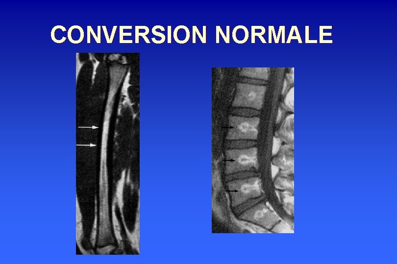 CONVERSION NORMALE 