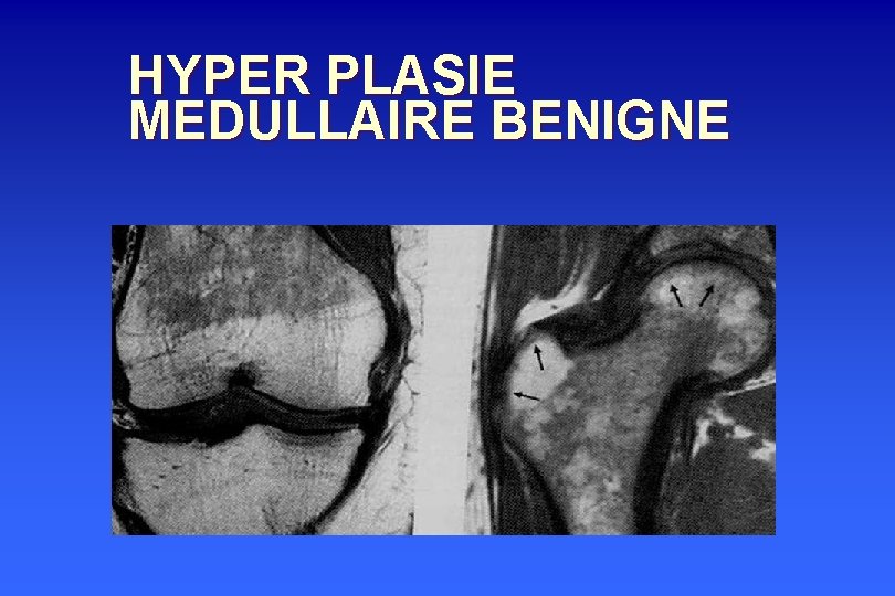 HYPER PLASIE MEDULLAIRE BENIGNE 