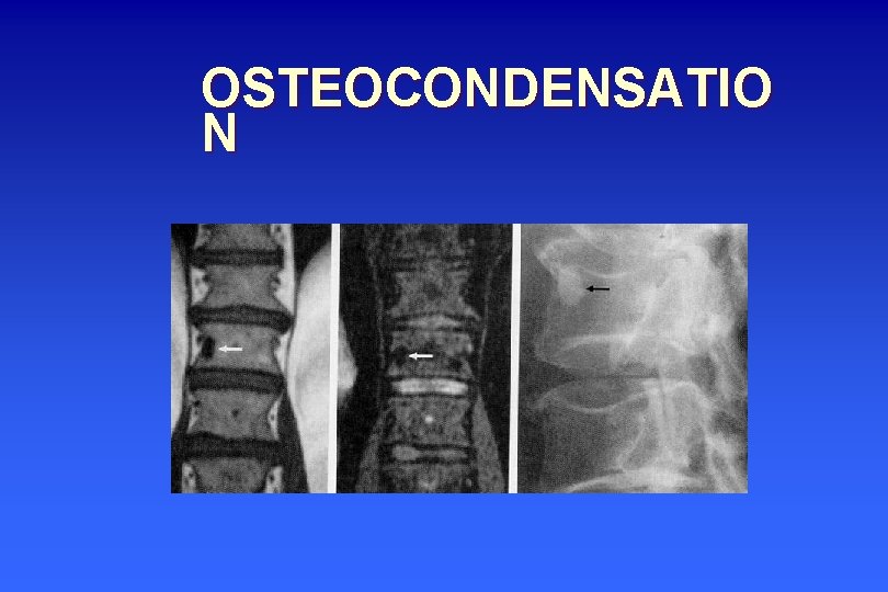 OSTEOCONDENSATIO N 