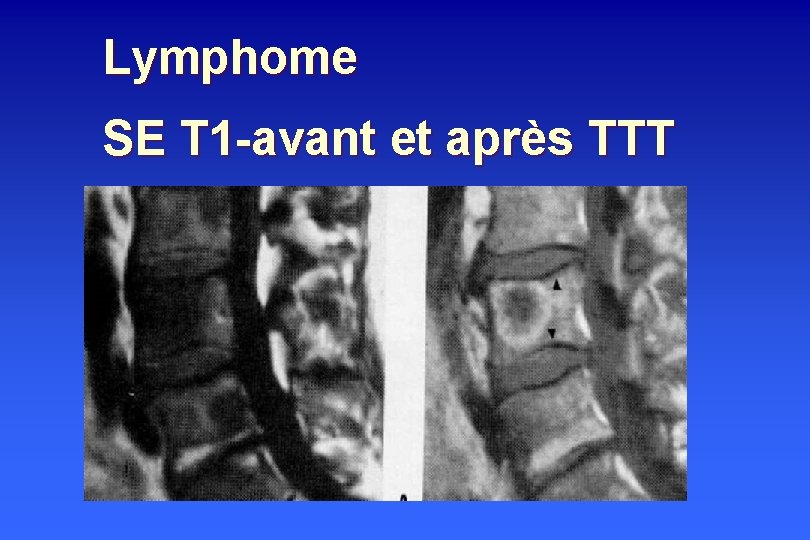 Lymphome SE T 1 -avant et après TTT 