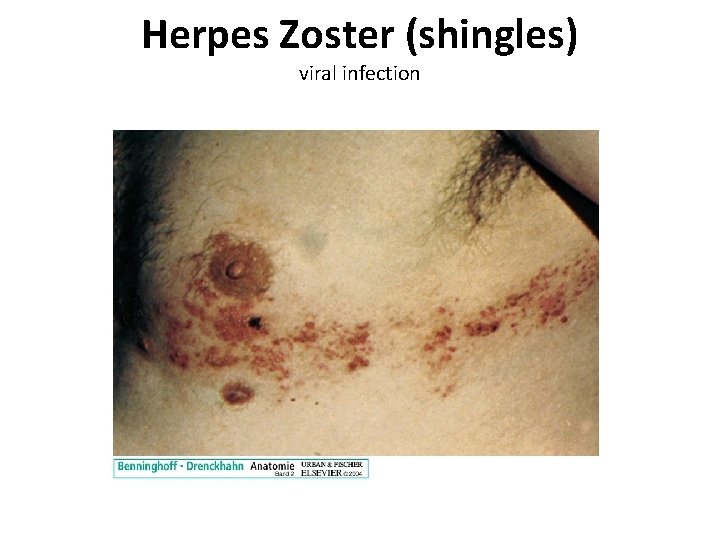 Herpes Zoster (shingles) viral infection 