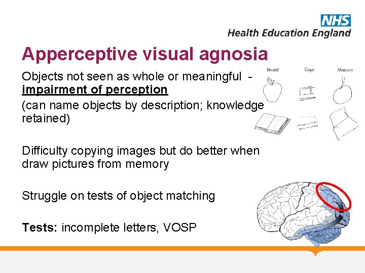 Apperceptive visual agnosia Objects not seen as whole or meaningful impairment of perception (can