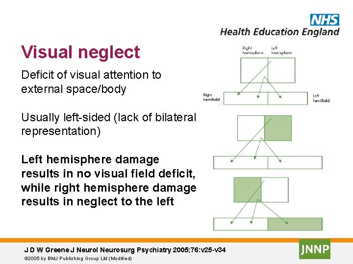Visual neglect Deficit of visual attention to external space/body Usually left-sided (lack of bilateral