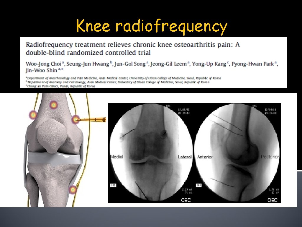 Knee radiofrequency 